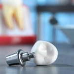 Понимание компонентов протезирования абатментов: улучшение реставраций зубов